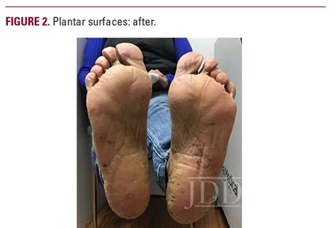 Verrucous Psoriasis Rare Variant And Novel Treatment Next Steps In