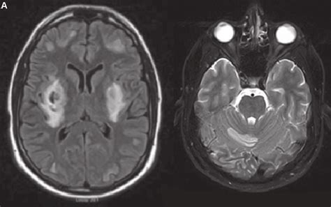 A Axial View Of T2 Weighted Mri On Admission Shows Bilateral Necrosis