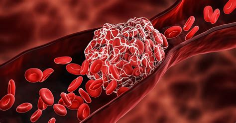 Blood Clot Symptoms And Causes Heart Research Institute