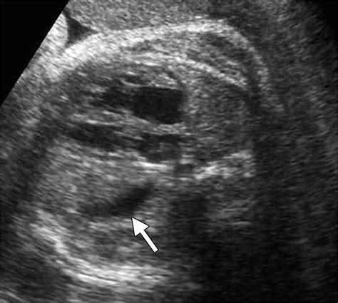 Left Sided Congenital Diaphragmatic Hernia Transverse Us Image Of The