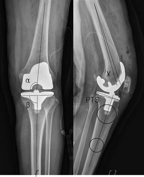 Posterior Tibial Slope Is A Modifiable Predictor Of Relatively Large