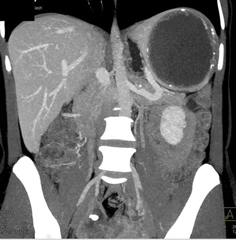 True Splenic Cyst Spleen Case Studies Ctisus Ct Scanning