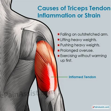 Triceps Tendon Inflammation Or Strainsymptomscausestreatment Ultrasound