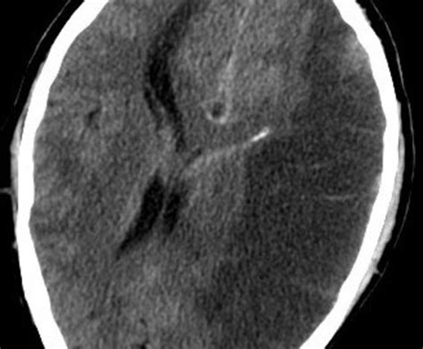 Focal cerebral ischemia (fci) is often results from a blood clot in the brain. Fisiopatología del EVC timeline | Timetoast timelines
