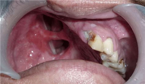 Single Step Fabrication Of A New Maxillary Obturator Prosthesis