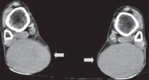 Plain Computed Tomography Scan Of Both Ankles Reveals Bilaterally