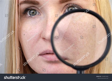 Enlarged Pores Black Spots Acne Rosacea Stock Photo Edit Now 1594831669