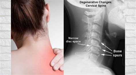 This causes narrowing of the spinal canals and thickening in the. Neck pain: Cervical Spondylosis. What is Spondylosis & do ...