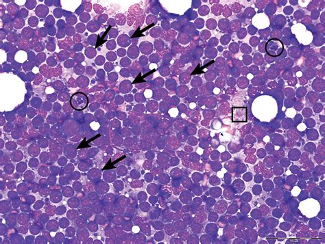 Top 5 Cytologic Findings In Aspirates Of Enlarged Lymph