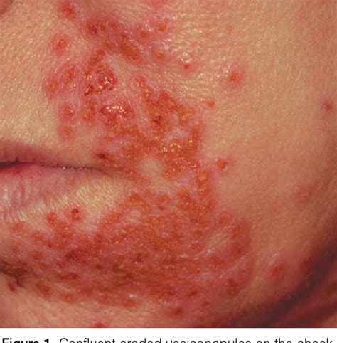 Figure 1 From Oral Dosing Regimen For Eczema Herpeticum In