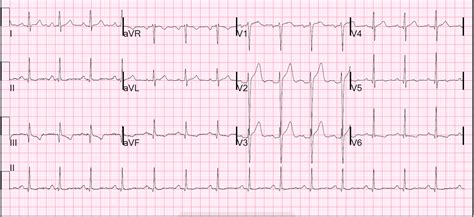 Reciprocal changes in an ami posterior mi ischemia/nstemi bundle branch block left ventricular hypertrophy. Dr. Smith's ECG Blog: Anterior ST elevation: Anterior ...