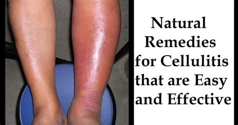 Natural Remedies For Cellulitis That Are Easy And Effective Health Tips