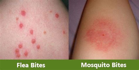 Scabies Vs Bed Bugs Bed Design