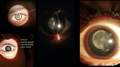 Zonular Cataract Video Compilation Of Distant Direct Ophthalmoscopy