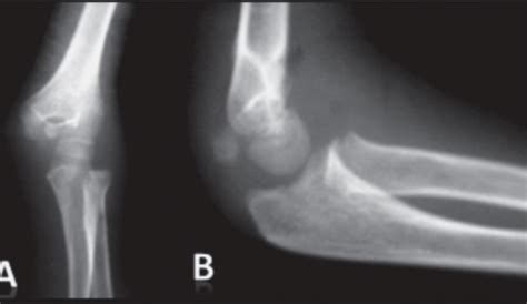 Elbow Dislocation Concise Medical Knowledge