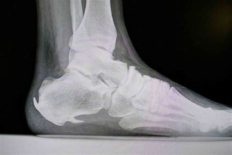 Heel Pain Heel Spur Plantar Fasciitis Friendly Footcare Inc