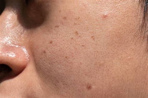 Sun Spots Vs Freckles What Are The Differences The District Weekly
