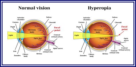 Hypermetropia Wimbledon Long Sightedness Fiona Watt Optometrists