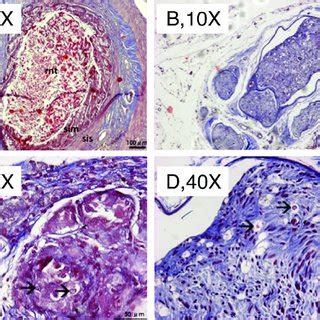 Seddon classification of nerve injuries (in 1941) Sunderland classification of nerve injury adapted from ...