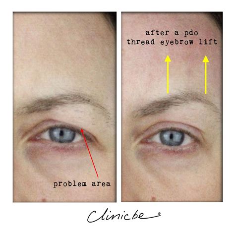 Pdo Thread Eye Lift Before And After