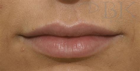 Lip Fillers And Heart Lips® Drbk Cosmetic Dentist And Aesthetics Clinic