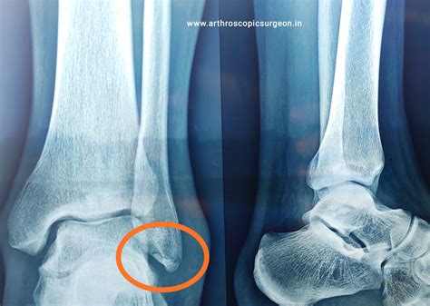 Ankle Sprain Best Orthopedic Doctor In Jaipur