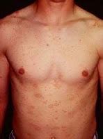 Sep 28, 2018 · what is pityriasis alba? pityriasis rosea causes, stages, and treatment | Share All ...