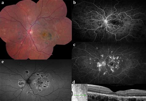 To present our findings and the course of acute posterior multifocal placoid pigment epitheliopathy (apmppe) with macular edema in a child. Multimodal Imaging of APMPPE, Related Disorders