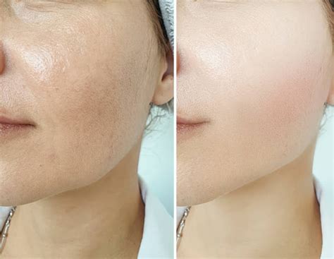 Before And After Skin Care Stock Photos Pictures And Royalty Free Images