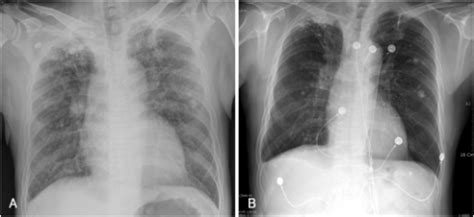 Chest Radiograph Demonstrates Bilateral Interstitial Sh Open I