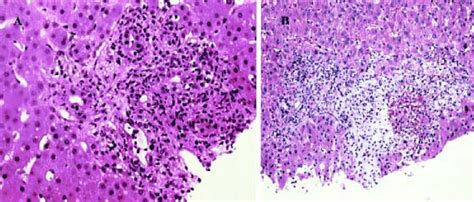 An immigration lawyer would be to have a regular basis for this reason online education prevents the america. Liver histology shows portal edema and early fibrosis ...