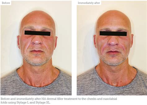 Case Study Treating Male Nasolabial Folds Aesthetics