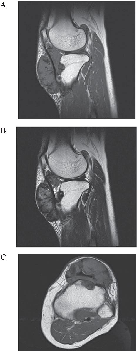 Figure 3 From Giant Cell Tumor Of The Tendon Sheath Extending Around