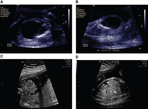 Congenital Cytomegalovirus Infection Presenting As A Fetal Intra