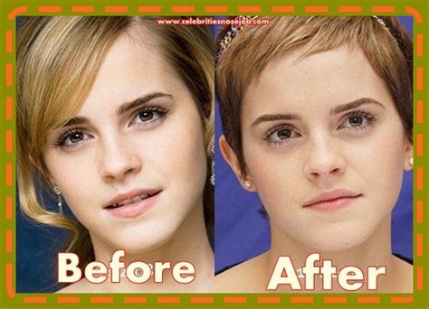 Emma Watson Plastic Surgery Nose Job Rhinoplasty Surgeons Rumors