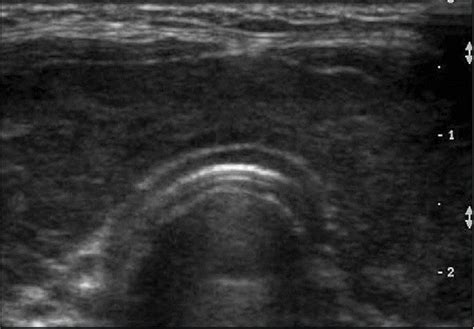 Thyroid Ultrasonotraphic Finding Ultrasonography Showing A Diffuse
