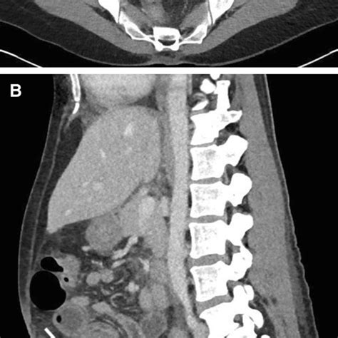 Postsurgical Abdominal Wall Hernia As A Complication Of A Cesarean