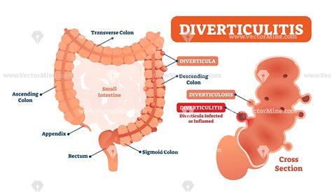 It is located in the left it is the primary organ of the digestive system that is involved in the second phase of food digestion. Diverticulitis anatomical vector illustration diagram ...
