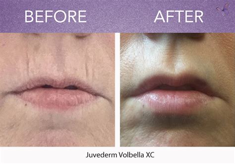 Volbella Lip Lines Before And After