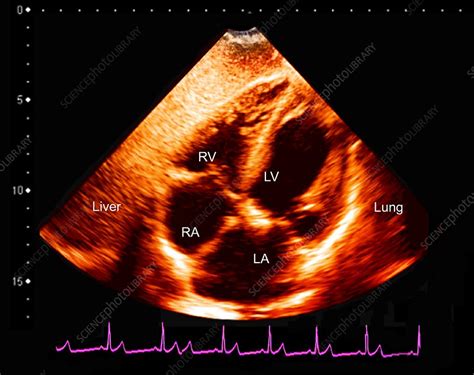 Normal heart, ultrasound scan - Stock Image - C048/0782 - Science Photo