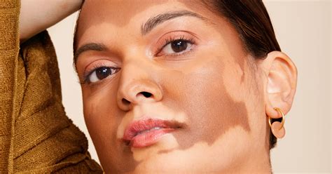 Vitiligo Skin Condition Causes And Treatments Popsugar Beauty