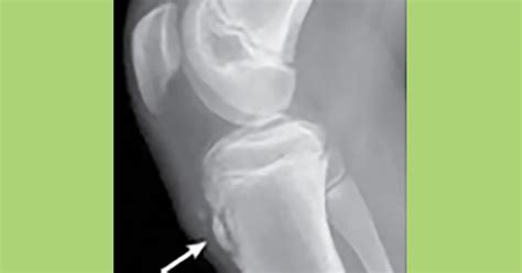 Knee Pain And Osgood Schlatter Disease
