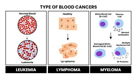 Blood Cancer Types