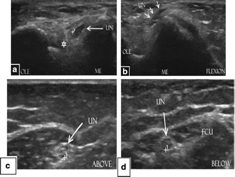 Role Of Dynamic Sonography In Ulnar Nerve Entrapment At Elbow The
