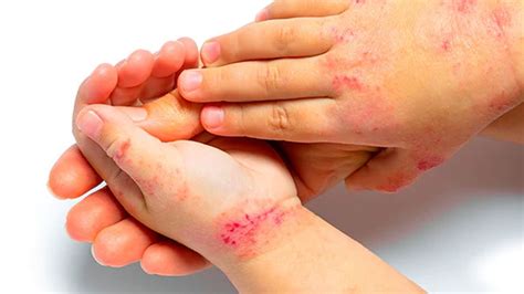 Dermatitis atópica la enfermedad en la piel que no deja dormir a los niños