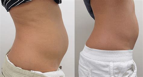 Botox And Sculpsure Before And After Gallery Kailua Hi Stuart Lerner Md