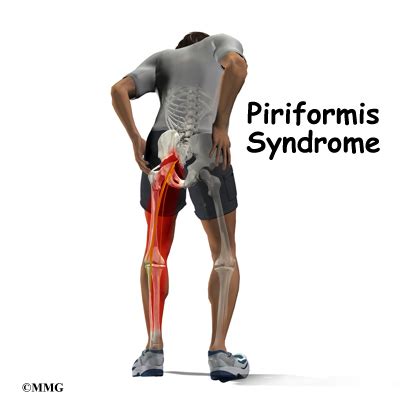 Piriformis Syndrome Mayo Hand Out My Xxx Hot Girl