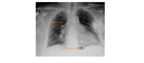 Crt, cardiac resynchronization therapy) are discussed in subsequent chapters. Imaging Case of the Week 137 | Emergucate