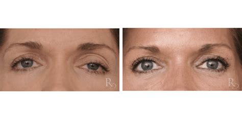 Before And After Ptosis Beverly Hills Ca