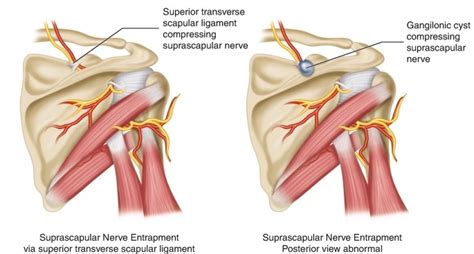 Suprascapular Nerve Injury